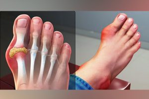 gout disease