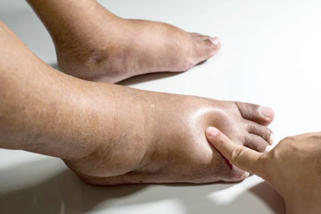 Peripheral Edema : Signs And Causes | HealthNews24Seven
