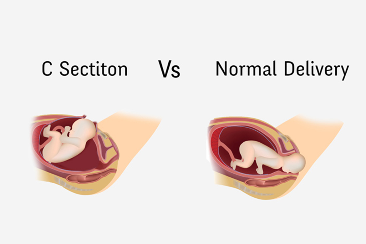 Everything You Need To Know About C Section Healthnews Seven