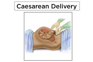 c-section