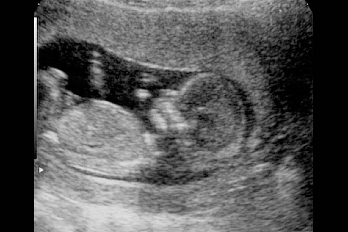 12 Недельный эмбрион УЗИ